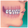 Crossbite