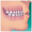 Underbite